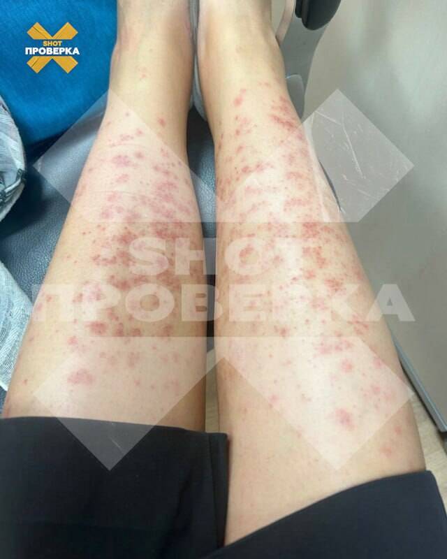 После первой процедуры лазерной эпиляции москвичка попала в больницу с ожогами